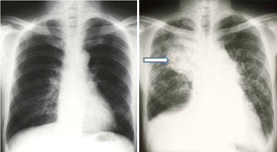 肺がんの胸部X線写真
